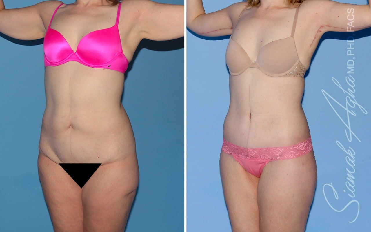 Total Body Lift Before & After