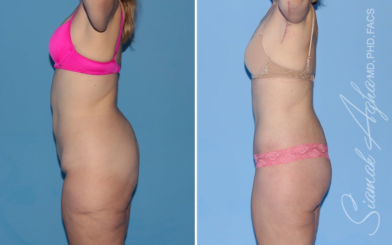 Total Body Lift Before & After