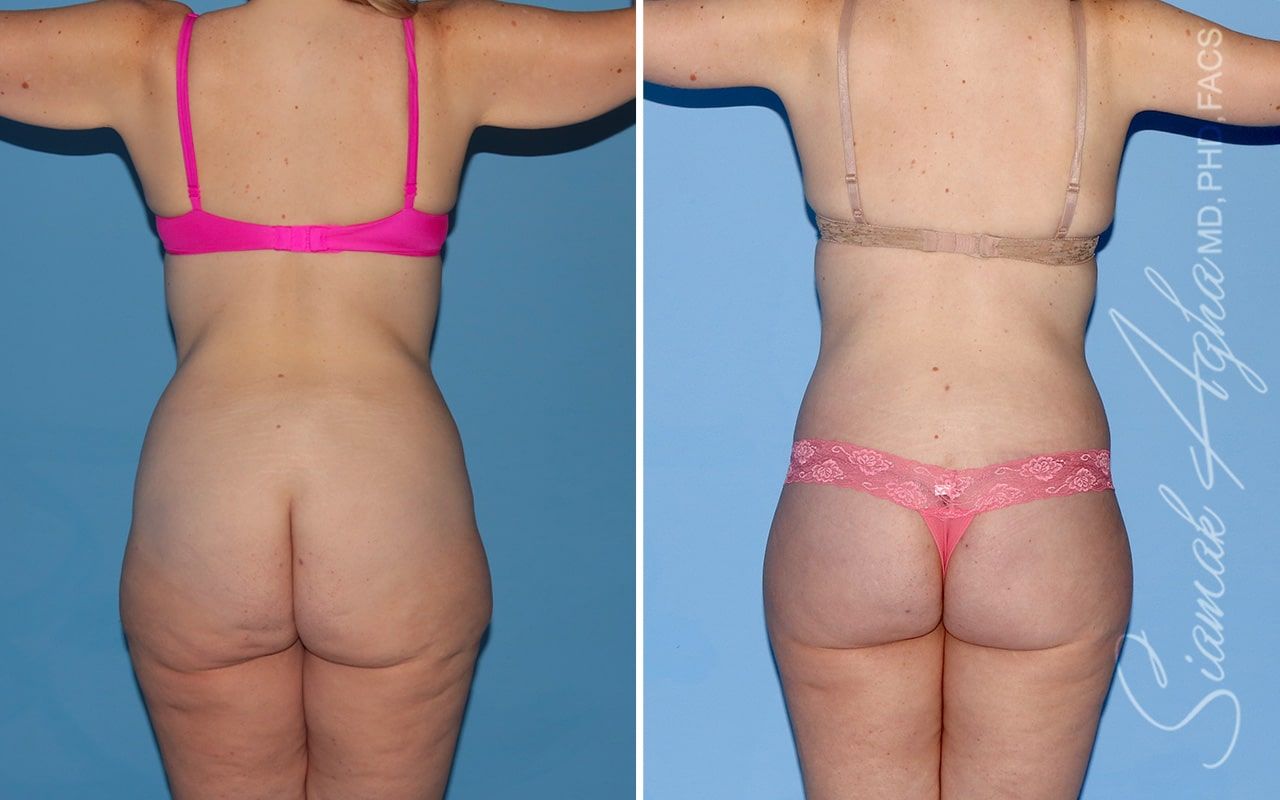 Total Body Lift Before & After