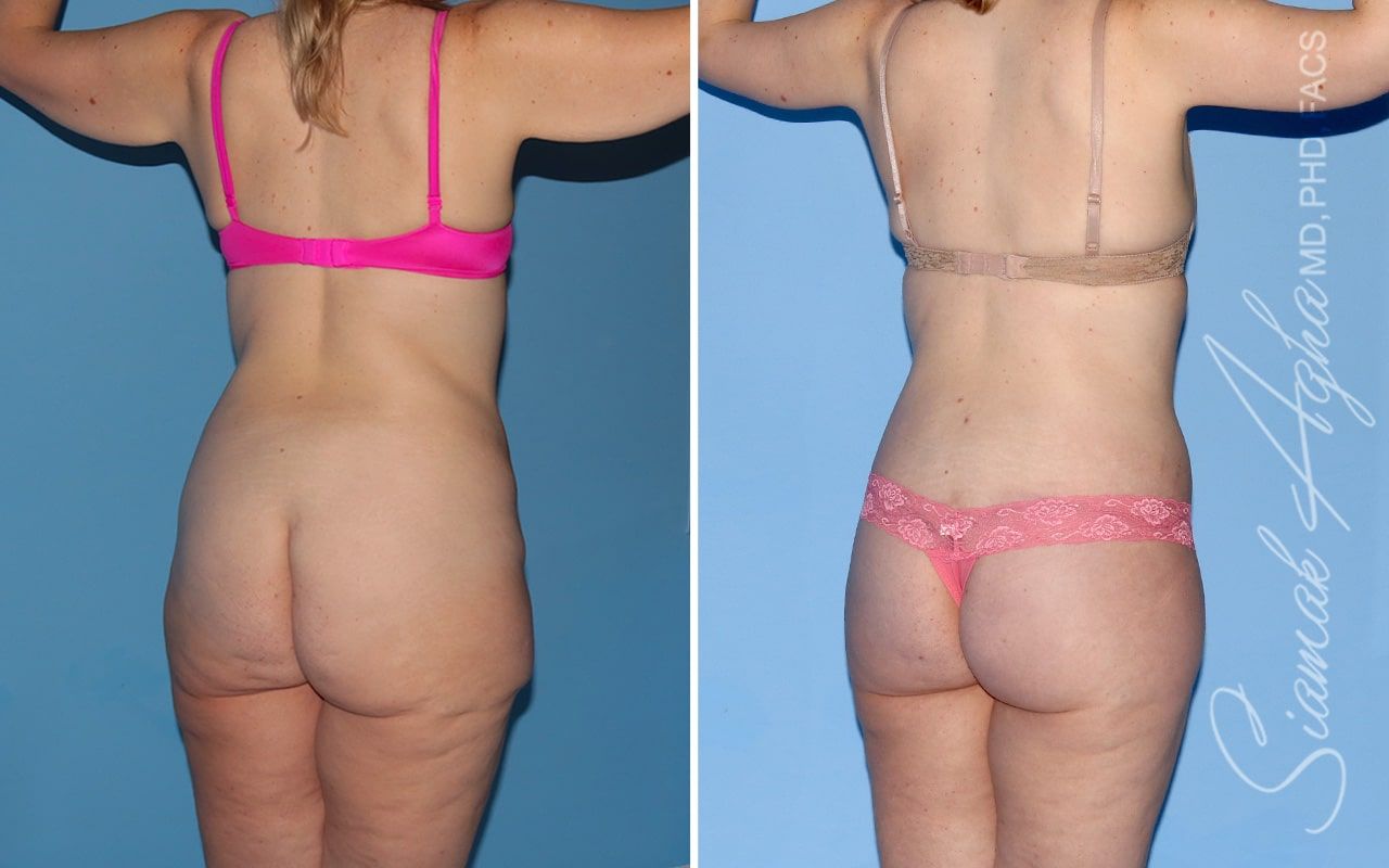 Total Body Lift Before & After