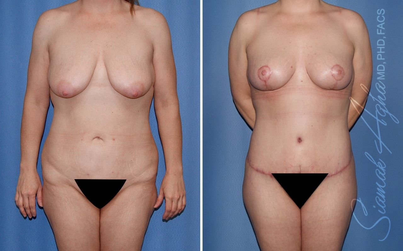 Total Body Lift Before & After