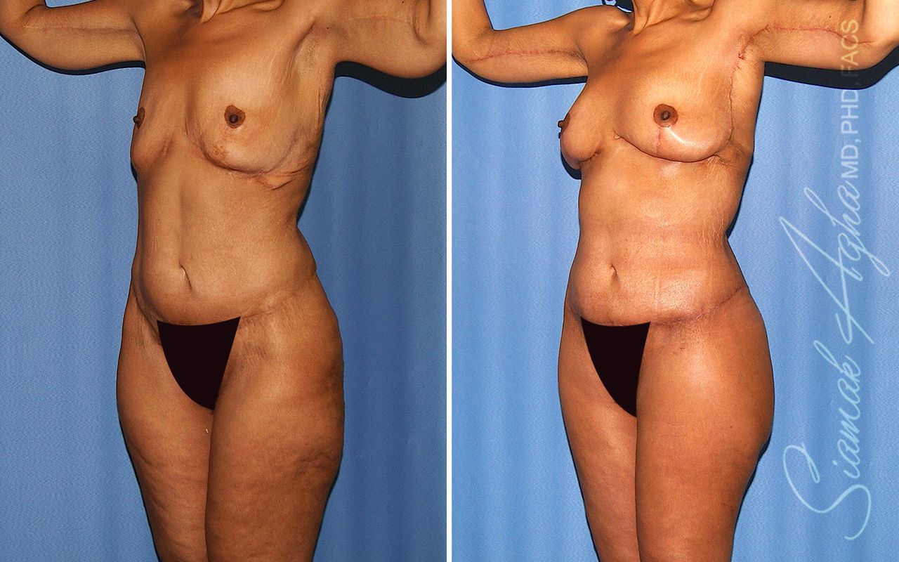 Total Body Lift Before & After
