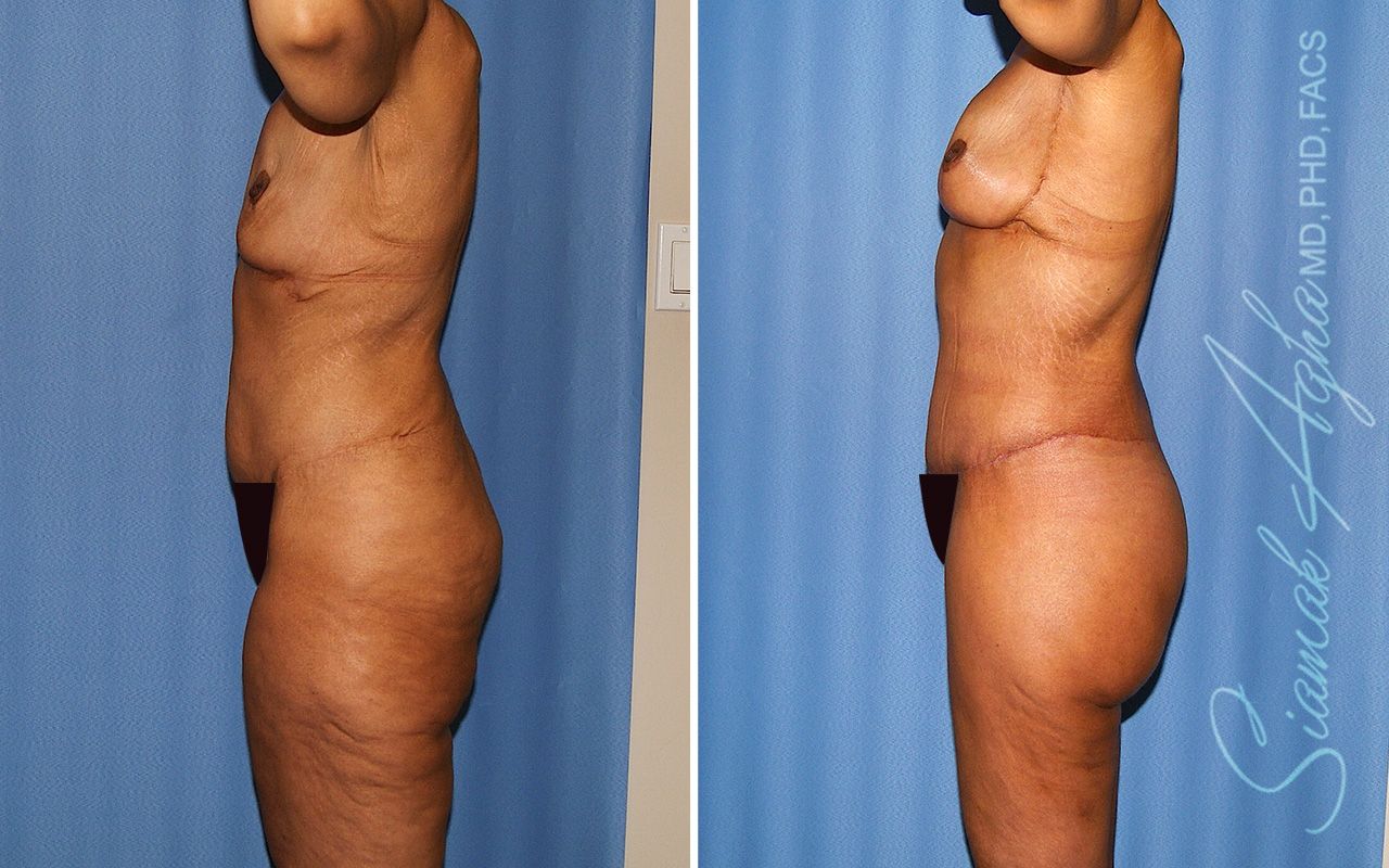 Total Body Lift Before & After