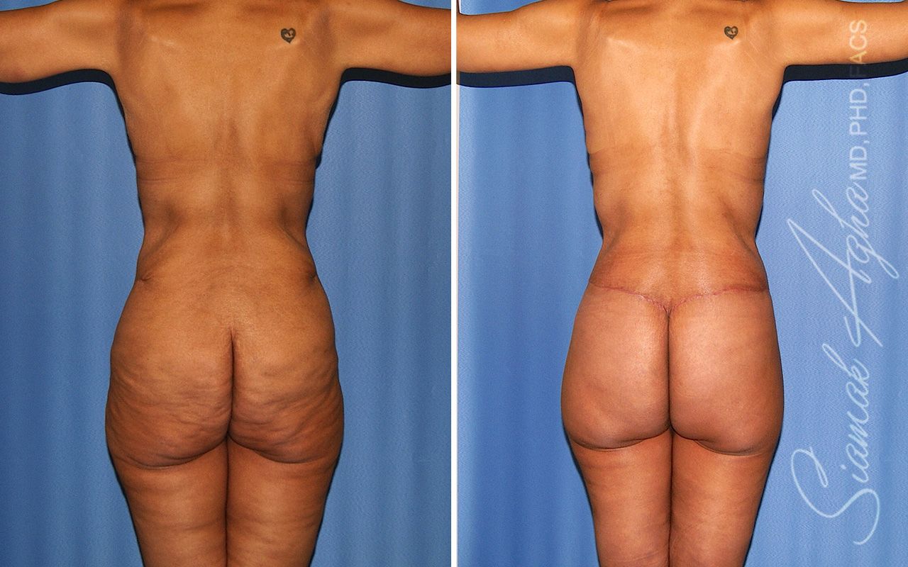 Total Body Lift Before & After