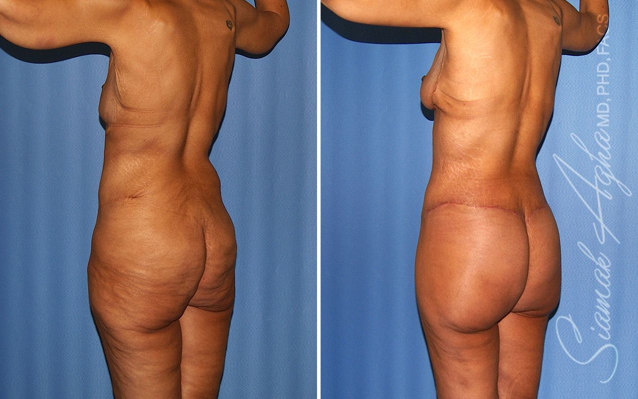 Total Body Lift Before & After