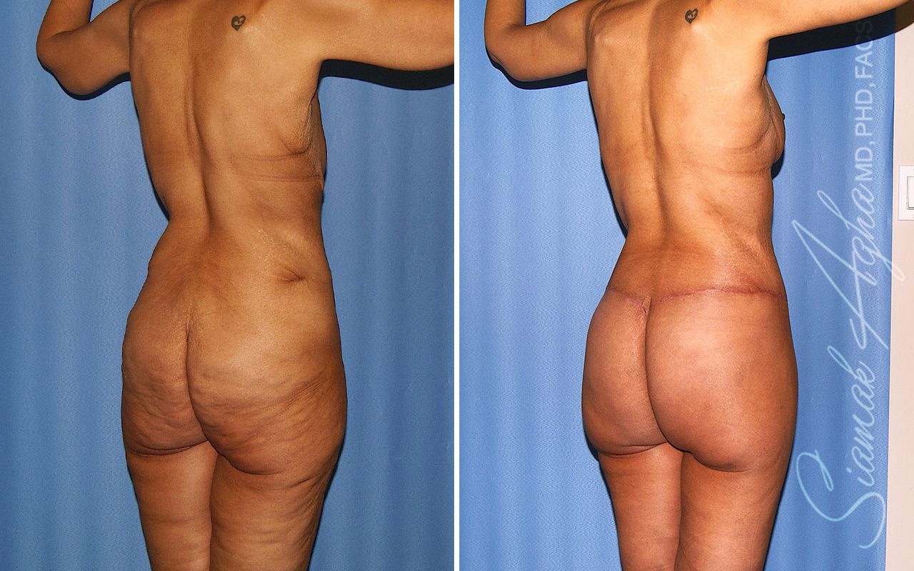 Total Body Lift Before & After
