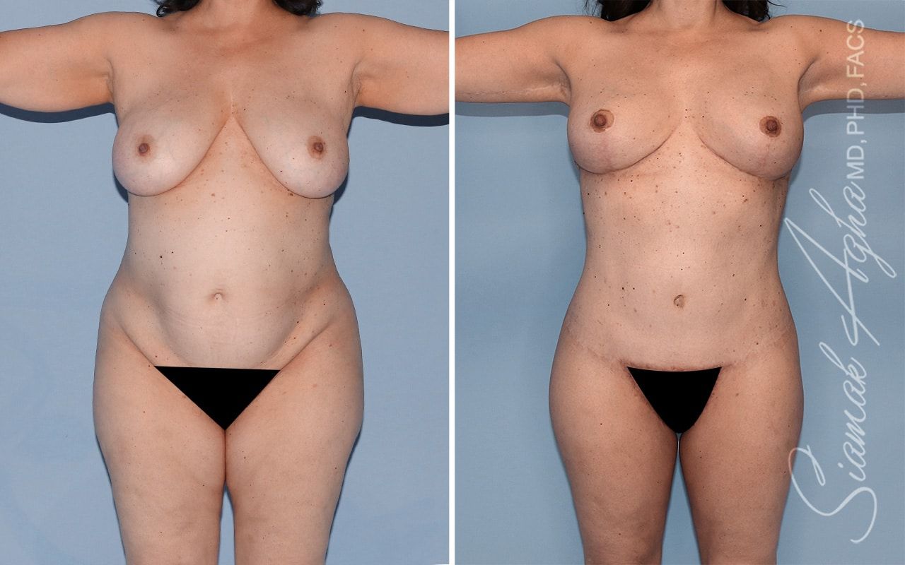 Total Body Lift Before & After