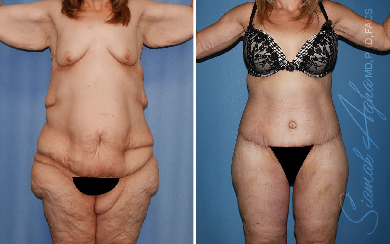 Total Body Lift Before & After