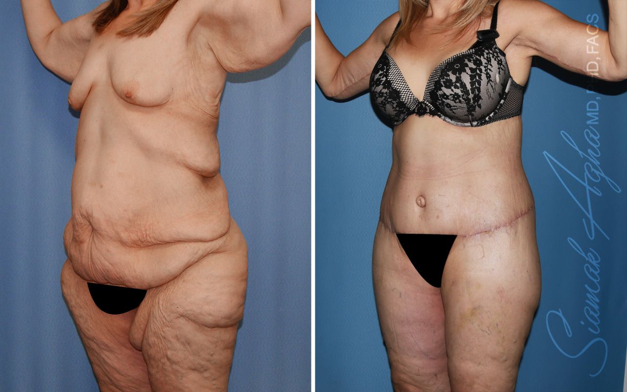 Total Body Lift Before & After