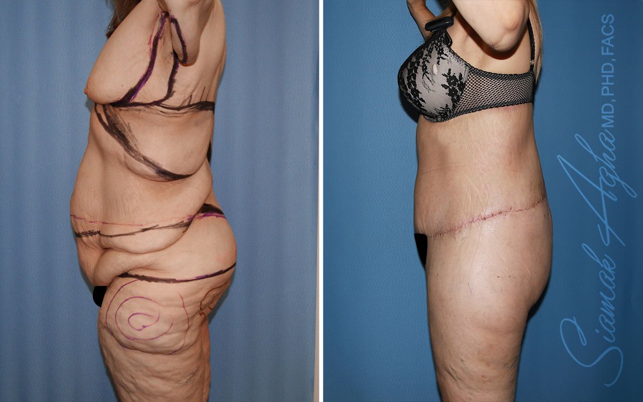 Total Body Lift Before & After