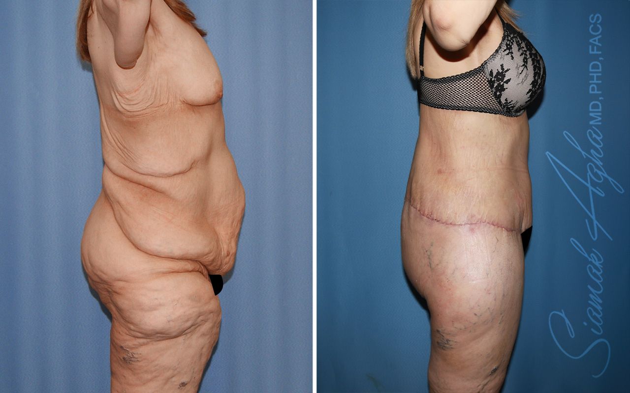 Total Body Lift Before & After