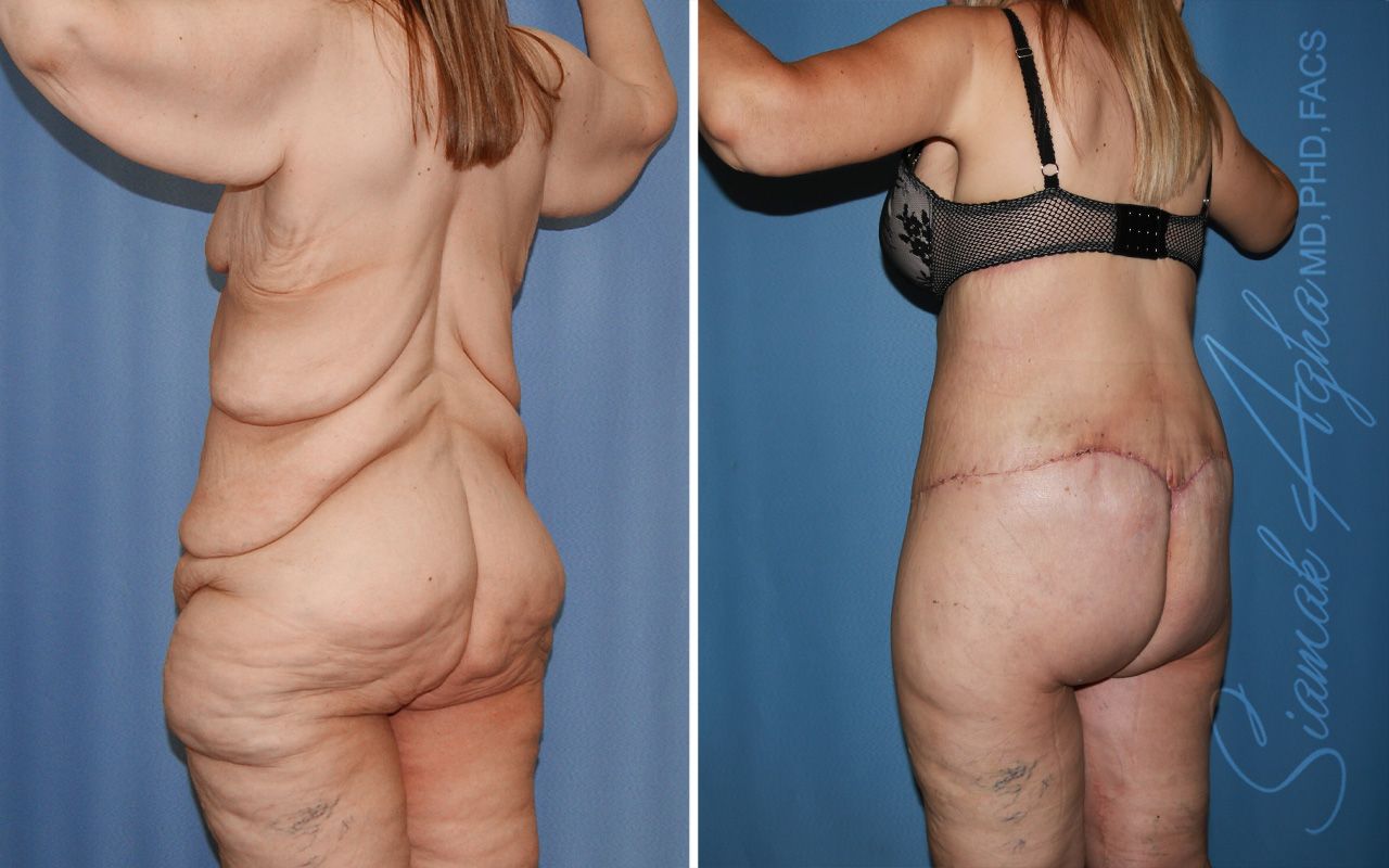 Total Body Lift Before & After