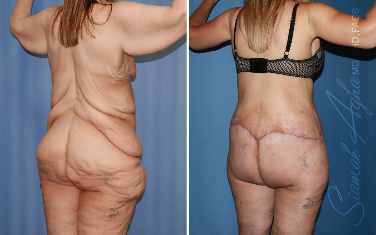 Total Body Lift Before & After