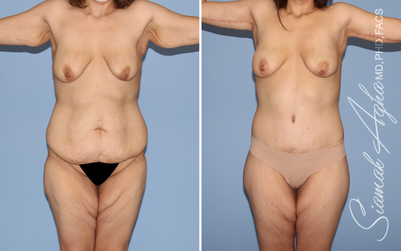 Total Body Lift Before & After