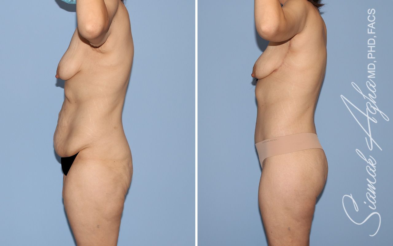 Total Body Lift Before & After