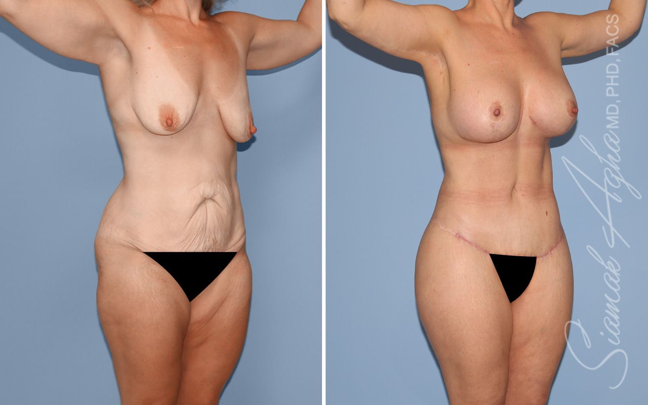 Total Body Lift Before & After