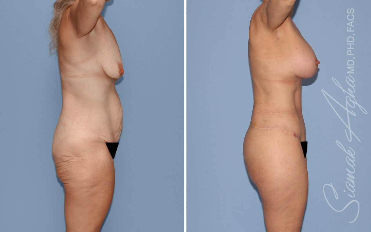 Total Body Lift Before & After