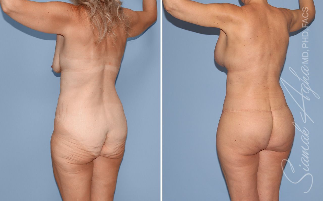 Total Body Lift Before & After