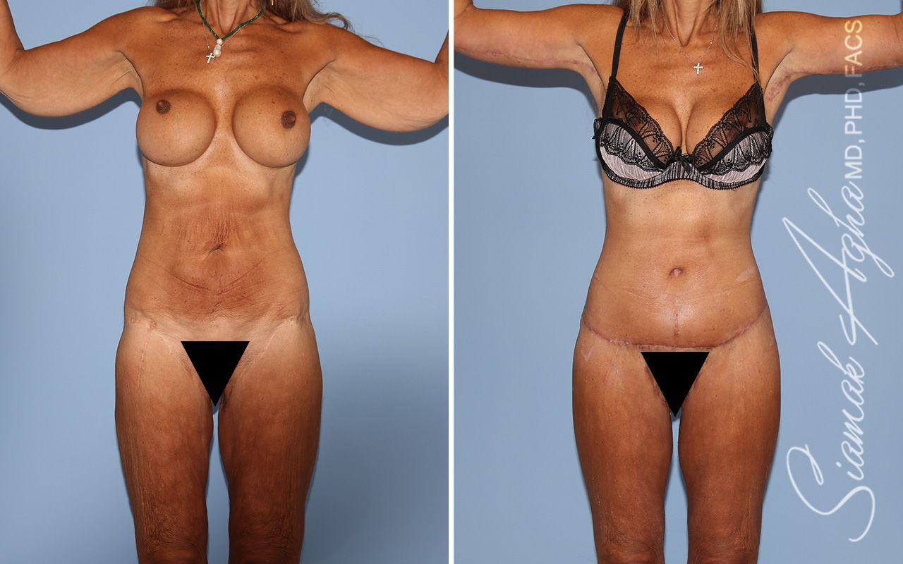 Total Body Lift Before & After