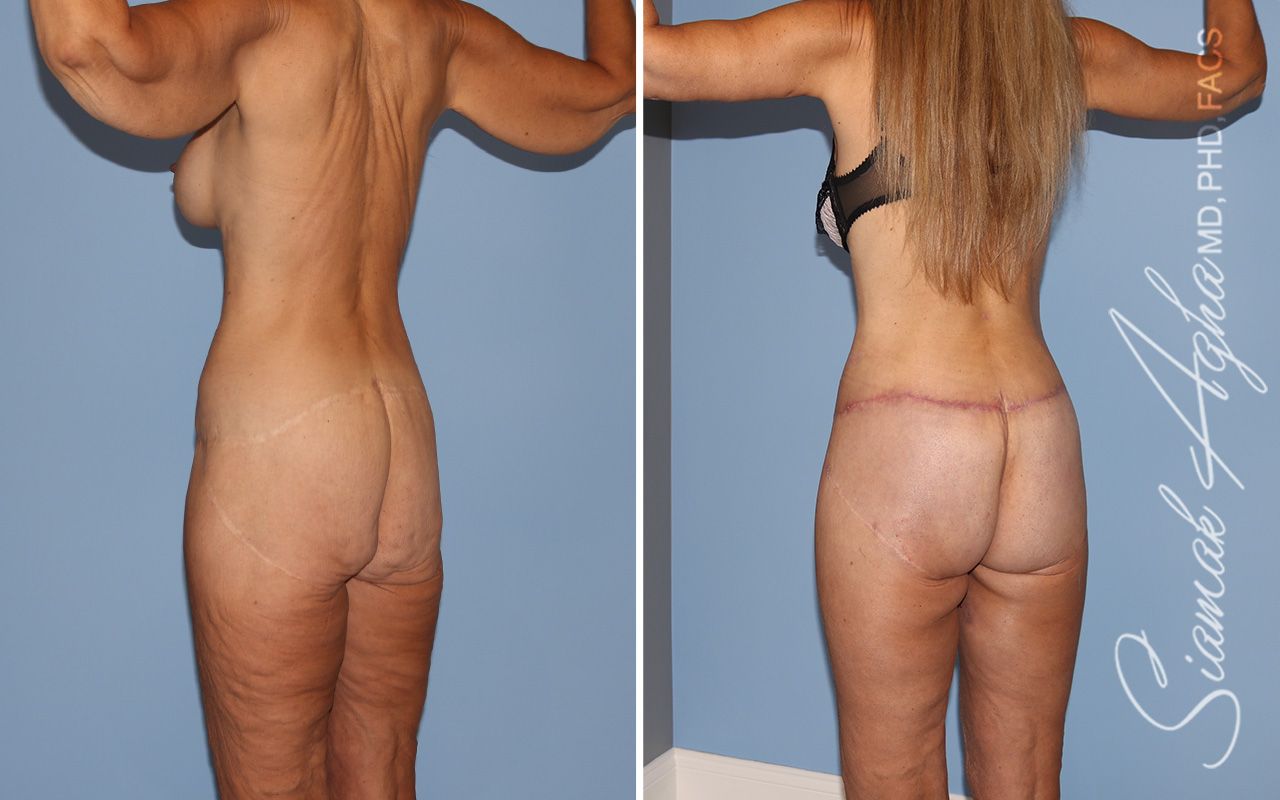 Total Body Lift Before & After