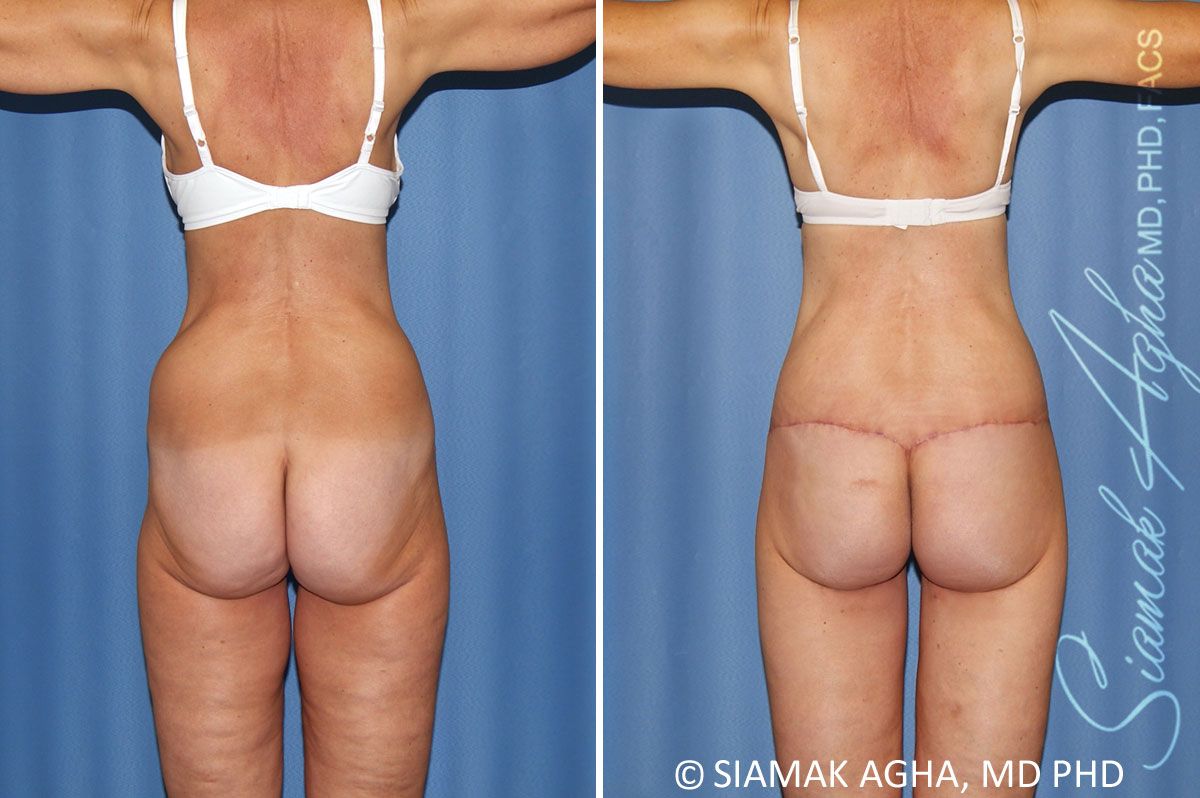 Total Body Lift Before & After