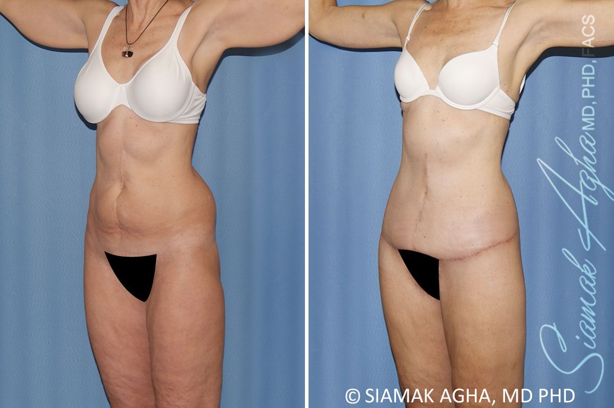 Total Body Lift Before & After