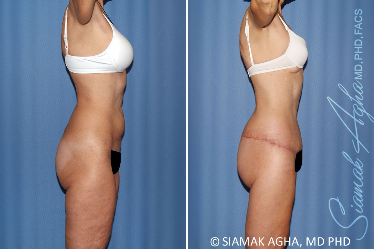 Total Body Lift Before & After