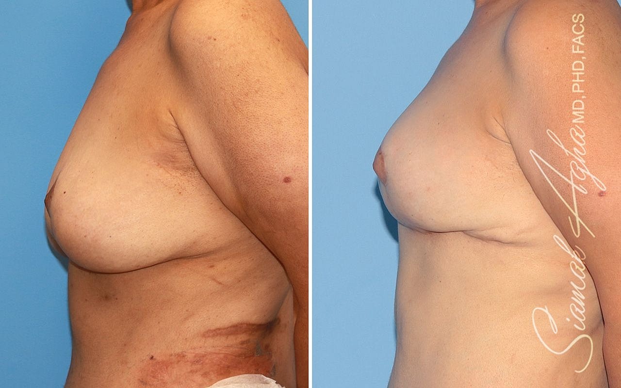 Breast Reconstruction Before & After