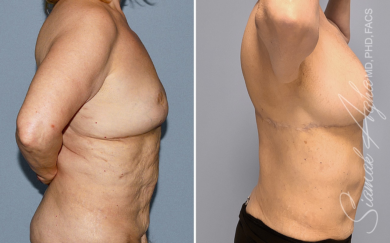 Breast Reconstruction Before & After