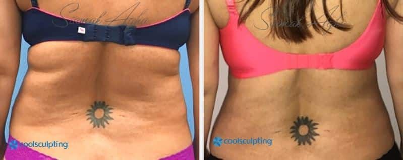 CoolSculpting Before & After