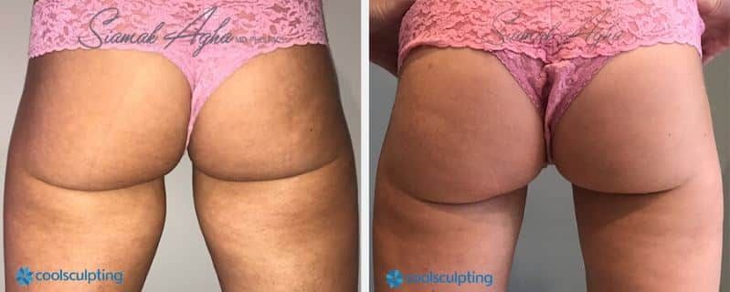 CoolSculpting Before & After