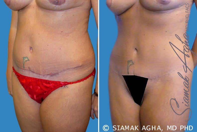 Tummy Tuck Revision Before & After