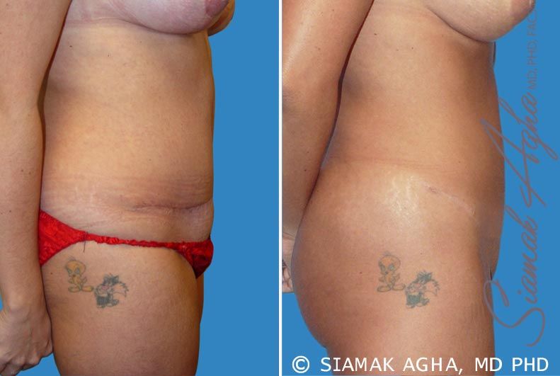 Tummy Tuck Revision Before & After