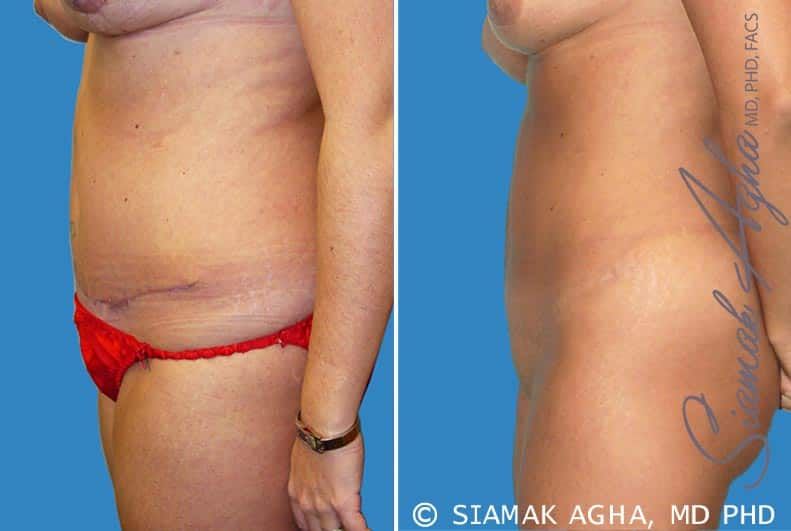 Tummy Tuck Revision Before & After