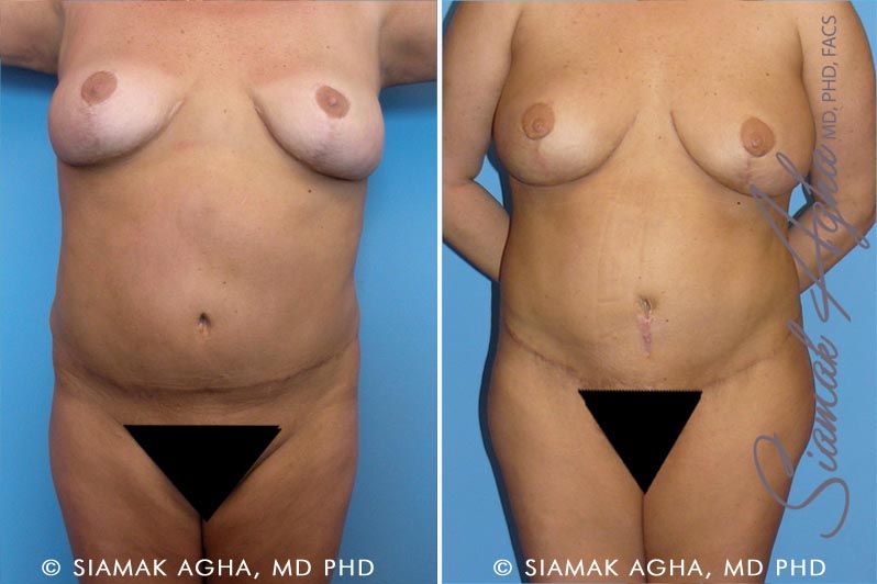 Tummy Tuck Revision Before & After