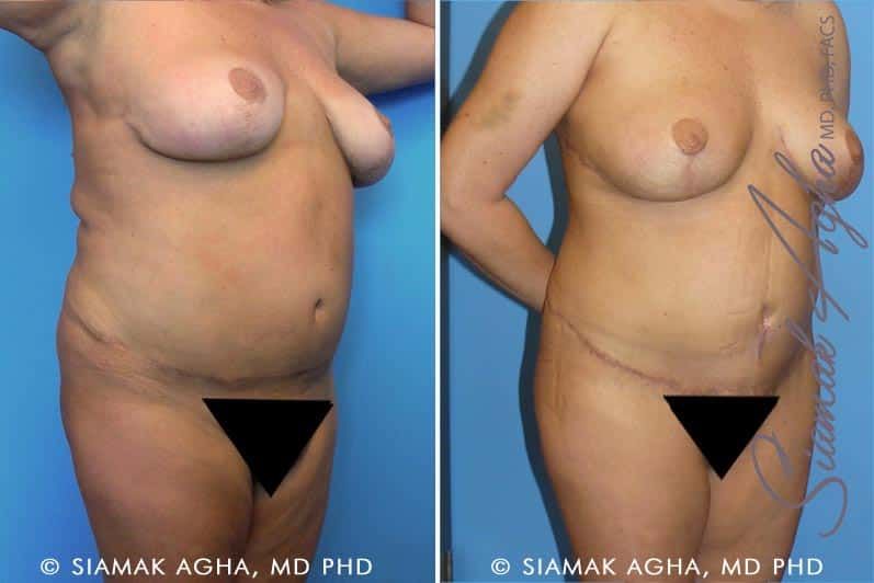 Tummy Tuck Revision Before & After