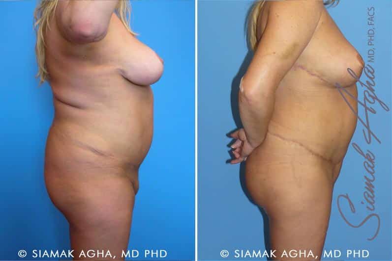 Tummy Tuck Revision Before & After