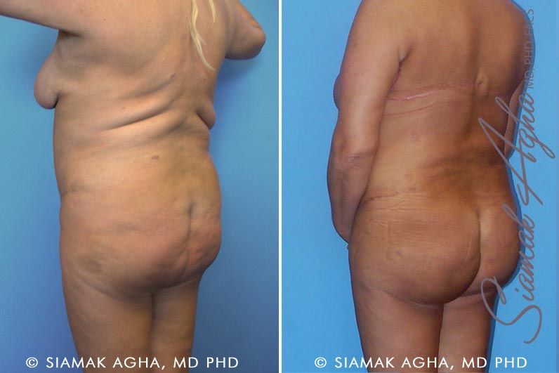 Tummy Tuck Revision Before & After