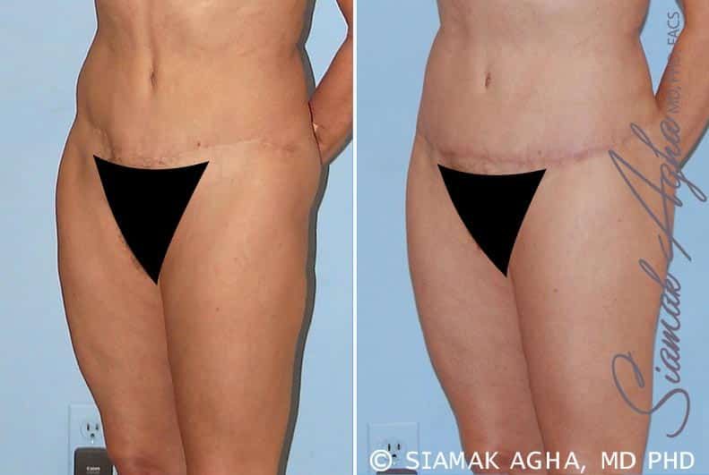 Tummy Tuck Revision Before & After