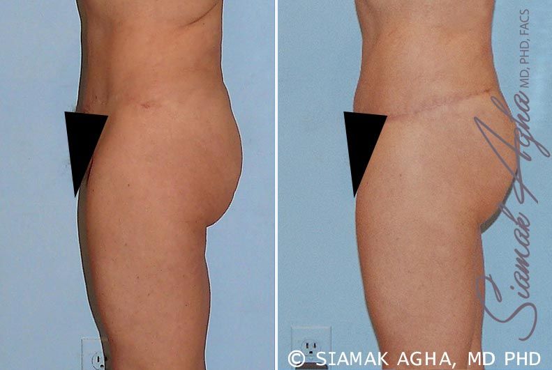 Tummy Tuck Revision Before & After