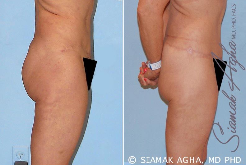 Tummy Tuck Revision Before & After
