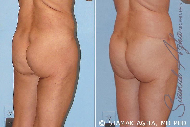 Tummy Tuck Revision Before & After