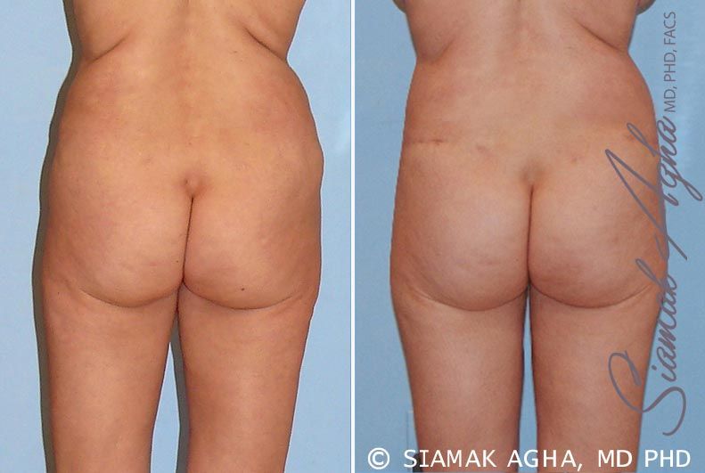 Tummy Tuck Revision Before & After