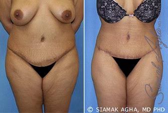 Tummy Tuck Revision Before & After