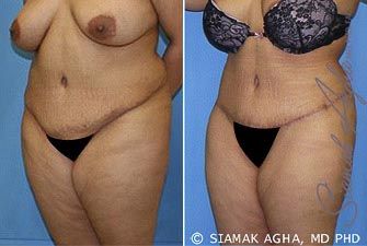 Tummy Tuck Revision Before & After