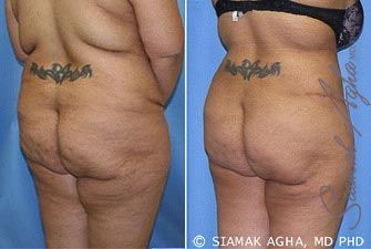 Tummy Tuck Revision Before & After