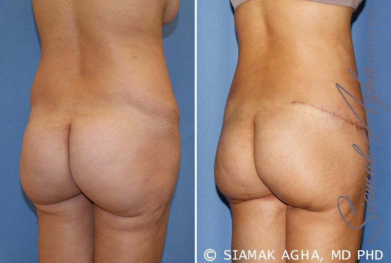 Tummy Tuck Revision Before & After