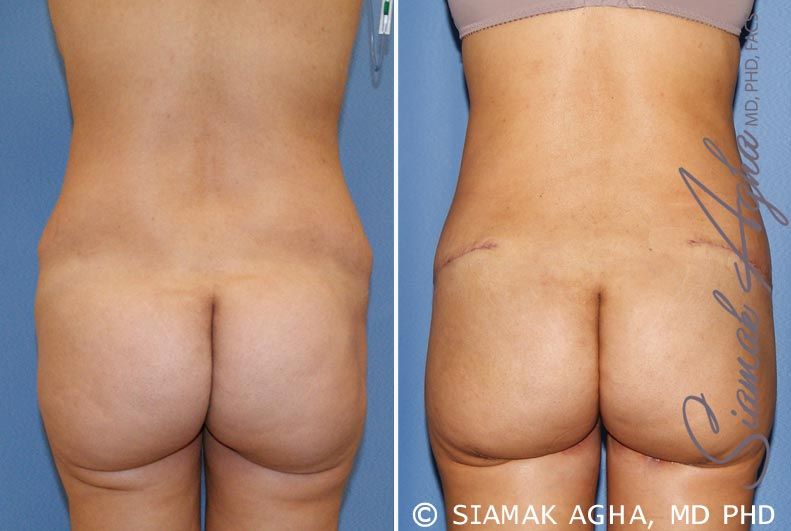 Tummy Tuck Revision Before & After