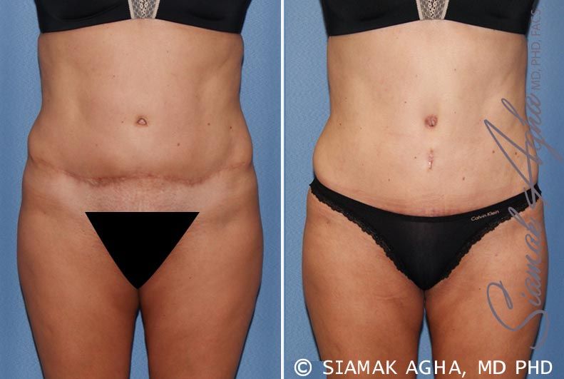 Tummy Tuck Revision Before & After