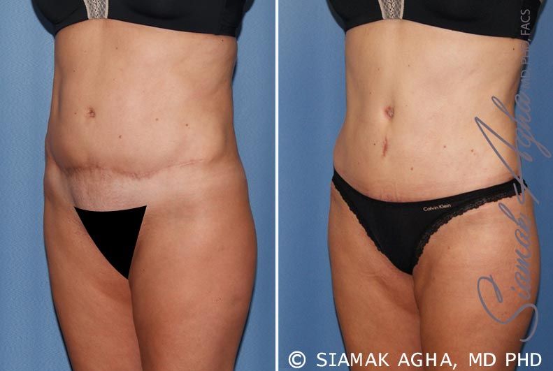 Tummy Tuck Revision Before & After